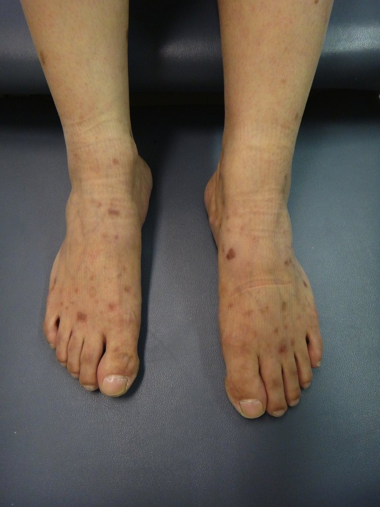 New Strategic Research Roadmap for Waldenstrom’s