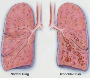 Bronchiectasis Treatment Natural Bronchiectasis Treatment Natural