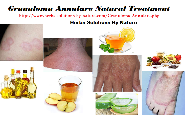 Generalized Granuloma Annulare Natural Treatment Generalized Granuloma Annulare Natural Treatment