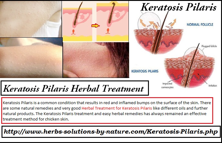 Hair Removal Natural Home Remedies Hair Removal Natural Home Remedies