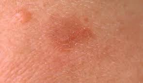 All There Is To Know About Actinic Keratosis