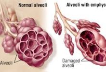 All There Is To Know About Emphysema