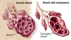 All There Is To Know About Emphysema