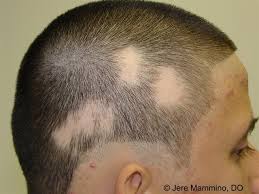 Alopecia Treatment, Diagnosis, Causes Of Alopecia, Symptoms