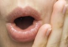 Burning Mouth Syndrome - A Very Painful Disorder