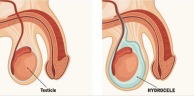 Hydrocele-Repair