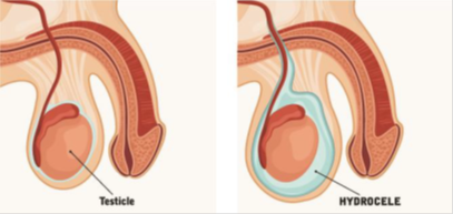 Hydrocele-Repair