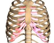 Costochondritis