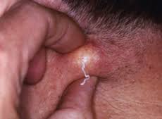 sebaceous cysts