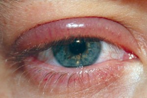 Protect Your Eyes From Blepharitis Common Eye Conditions