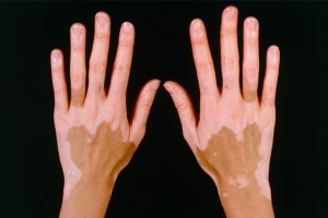 Vitiligo-300x200