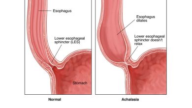 Achalasia Difficulty Swallowing Food and Liquids
