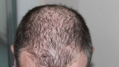 Alopecia Clinical Trials and Research Studies