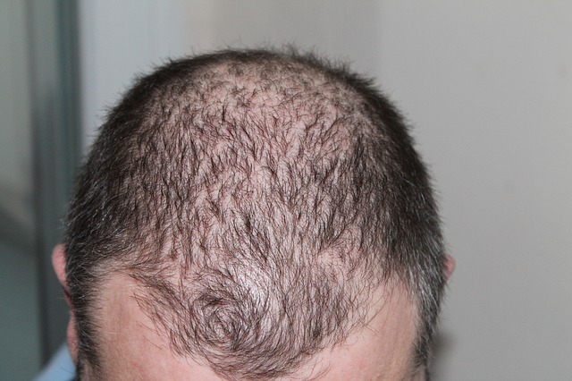 Alopecia Clinical Trials and Research Studies