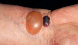 What Is Bullous Pemphigiod - This Skin Disease Causes Blisters