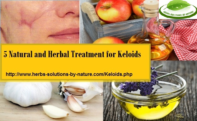 Keloid