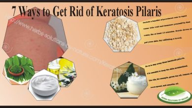 Keratosis-Pilaris 1