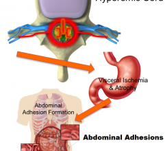 Pregabalin Reduces Abdominal Pain and Improves Sleep in Women with Adhesions