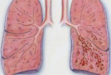 Bronchiectasis-300x261