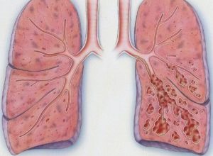 Bronchiectasis-300x261