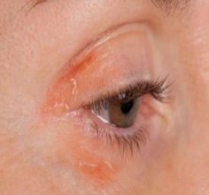 New Treatment for Blepharitis Dry Eye Developed
