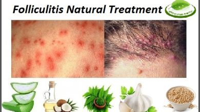 Folliculitis Natural Treatment