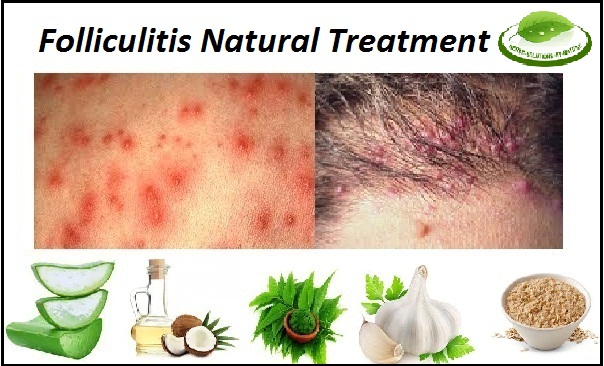 Folliculitis Natural Treatment
