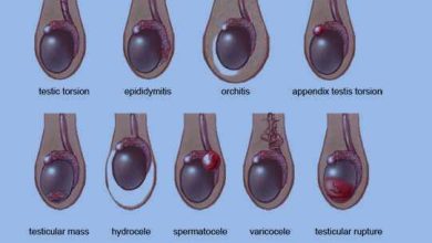 Epididymitis Natural Treatment