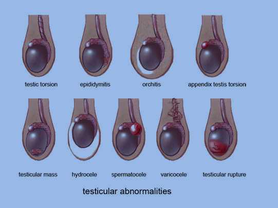 Epididymitis Natural Treatment