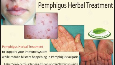 Pemphigus Herbal Treatment