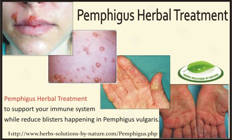 Pemphigus Herbal Treatment
