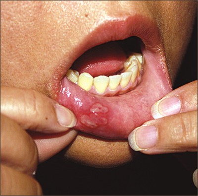 Oral Lichen Planus Treatment