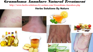 Granuloma Annulare Natural Treatment