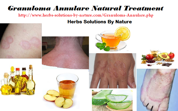 Granuloma Annulare Natural Treatment