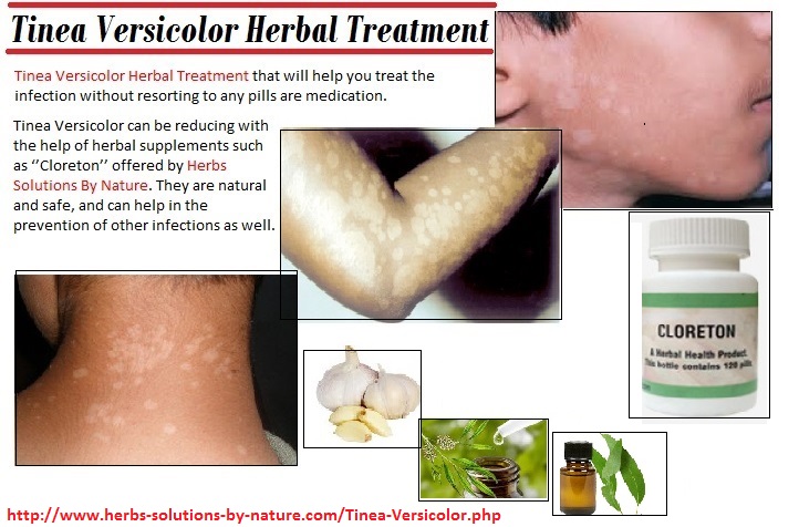 Pityriasis Natural Treatment Yeast Pityriasis Natural Treatment Yeast