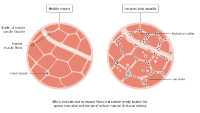 Inclusion Body Myositis New Treatment