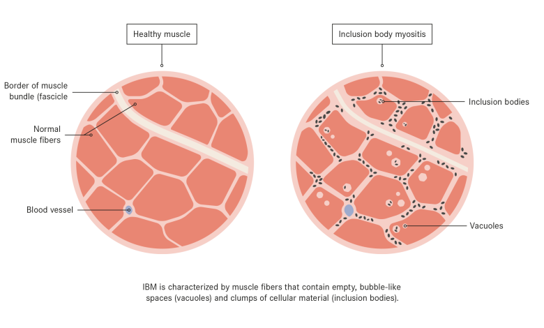 Inclusion Body Myositis New Treatment