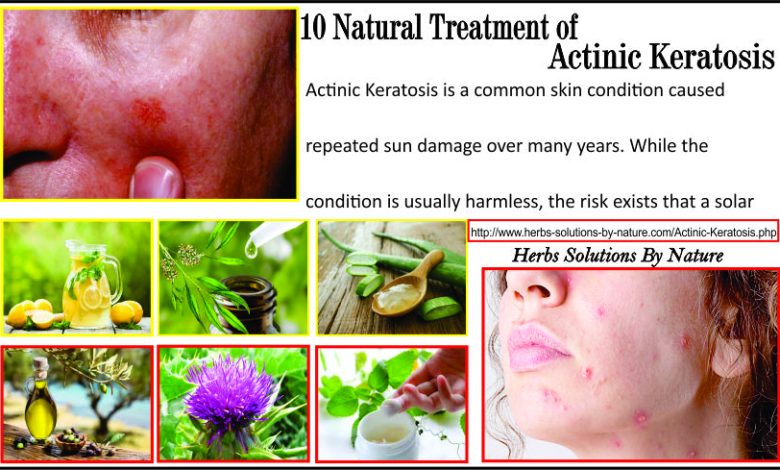 10 Natural Treatment of Actinic Keratosis