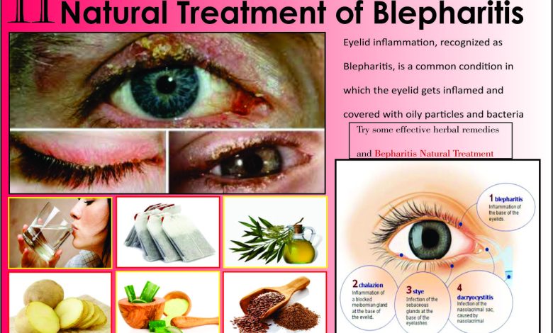 11 Best Natural Treatments of Blepharitis