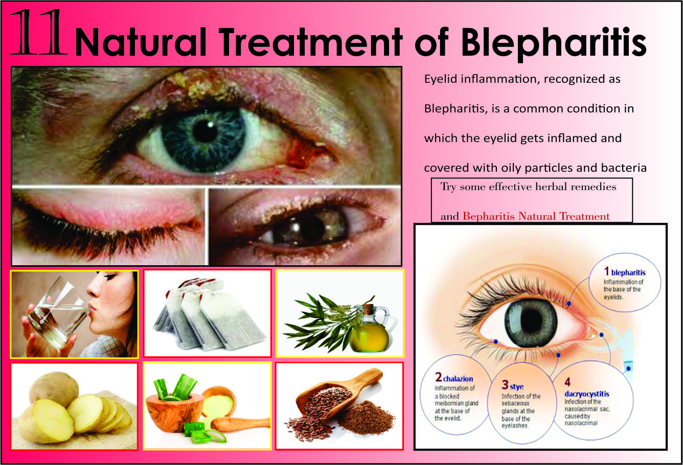 11 Best Natural Treatments of Blepharitis Herbs Solutions By Nature Blog