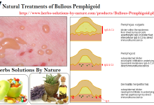 7 Natural Treatments of Bullous Pemphigoid