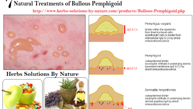7 Natural Treatments of Bullous Pemphigoid
