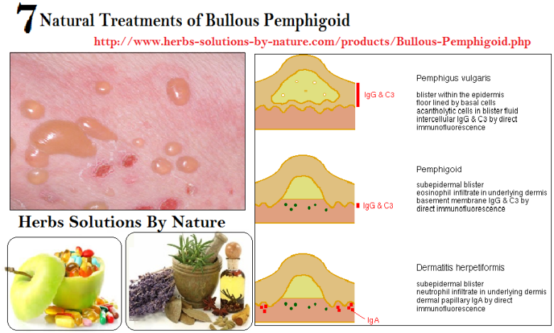 7 Natural Treatments of Bullous Pemphigoid