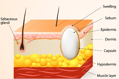 Sebaceous-Cyst