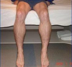 Inclusion-Body-Myositis
