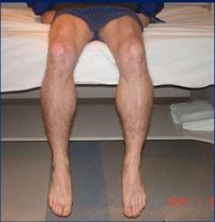 Inclusion-Body-Myositis