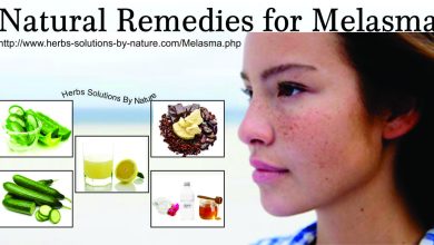 Melasma