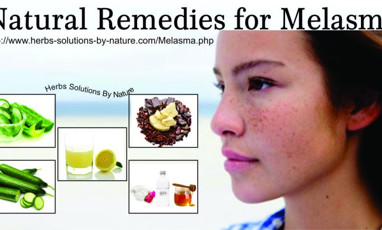Melasma