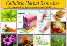 12 Herbal Remedies for Cellulitis Bacterial Skin Infection
