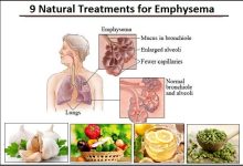 9 Natural Treatments for Emphysema to Recover Lung Function